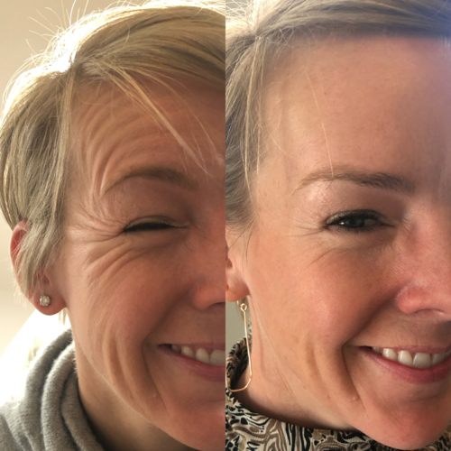 Botox before and after crows feet and glabella