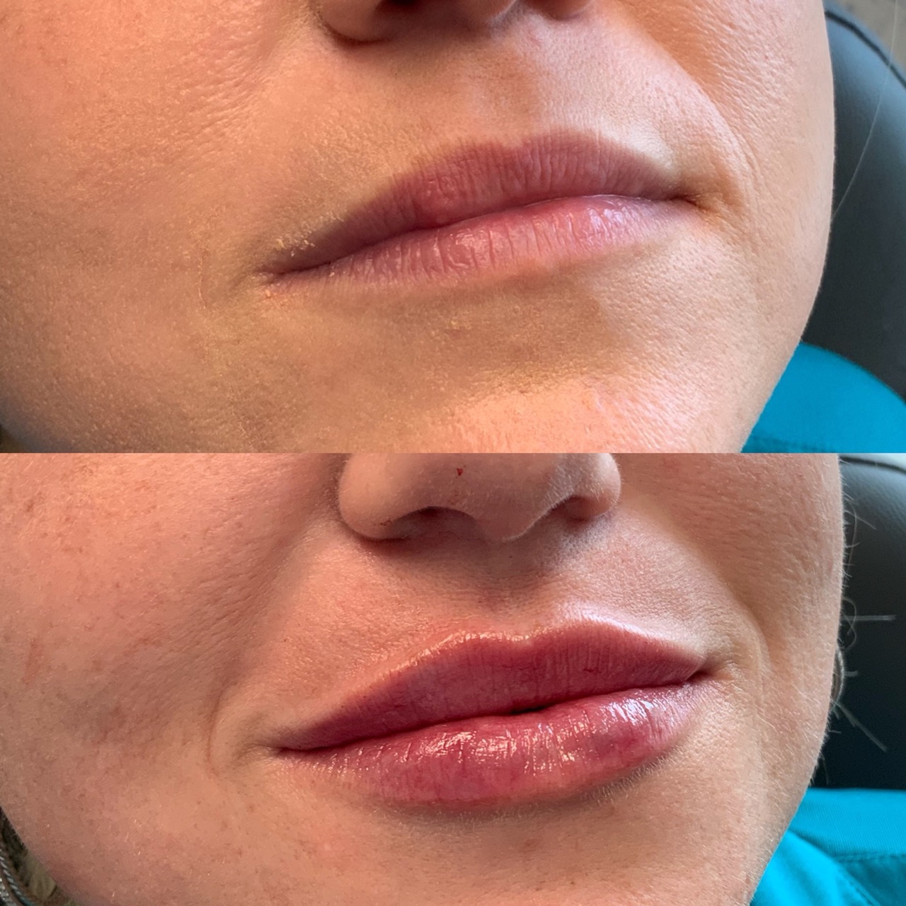 Lip fuller augmentation before and after