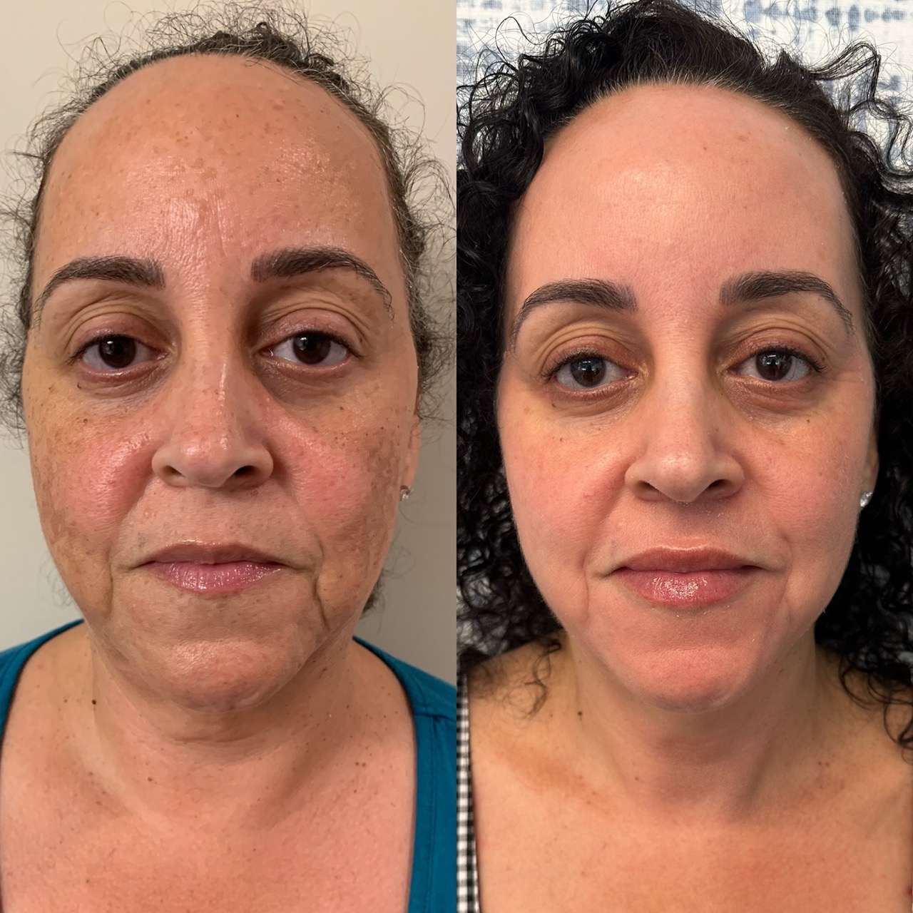 ZO Skin Health regimen before and after