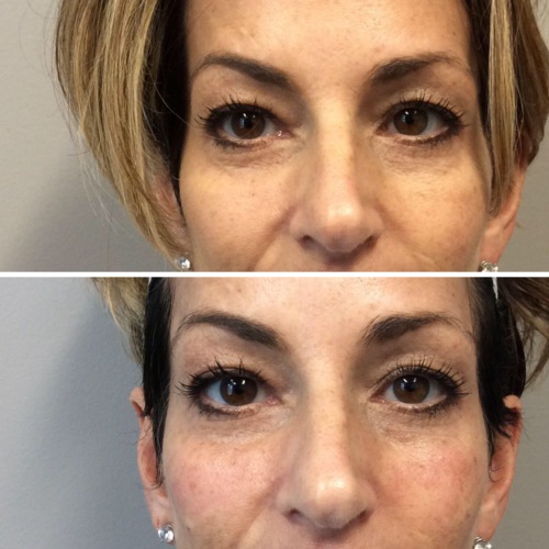 Temple and under eye filler before and after