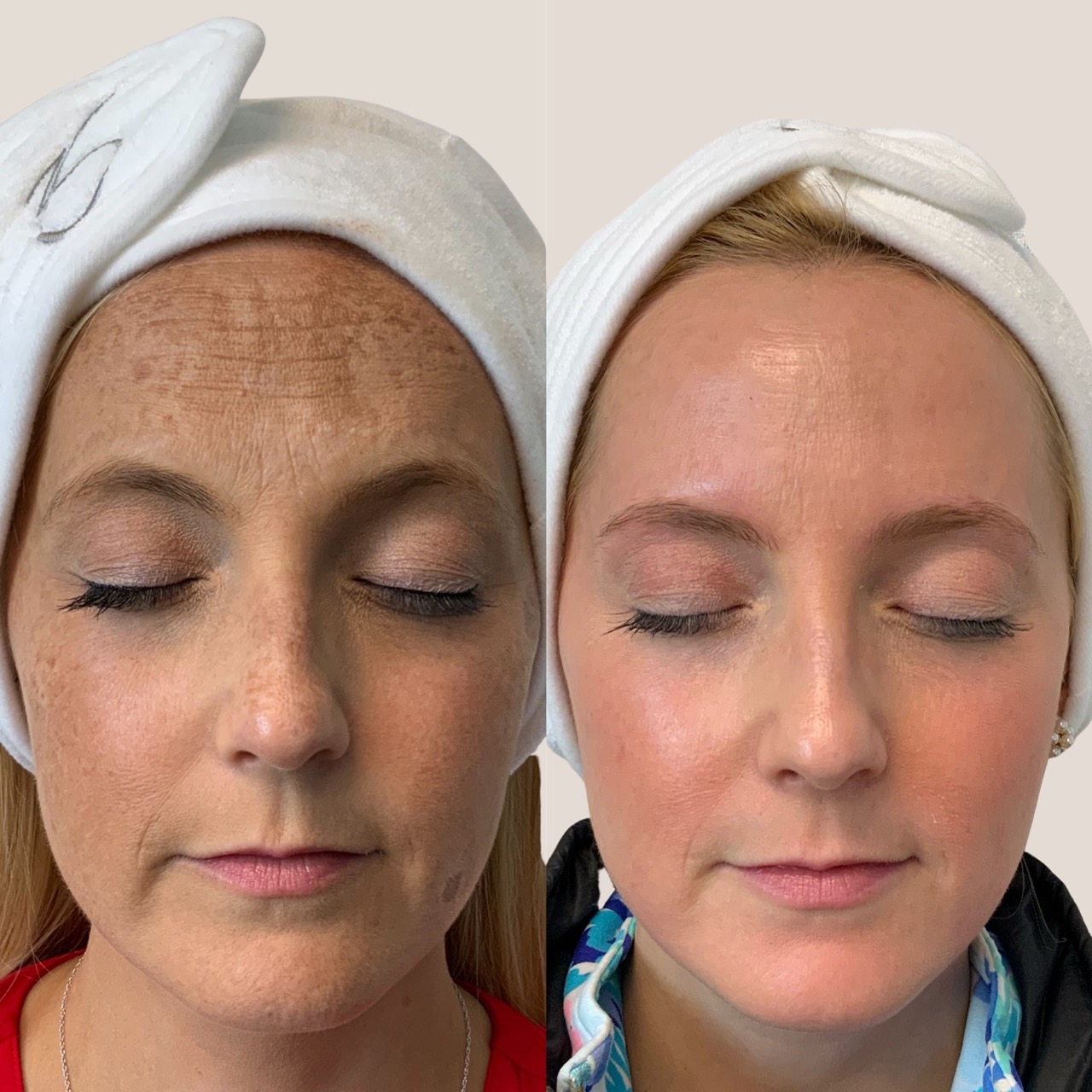 Before and after custom ZO Skin Health regimen