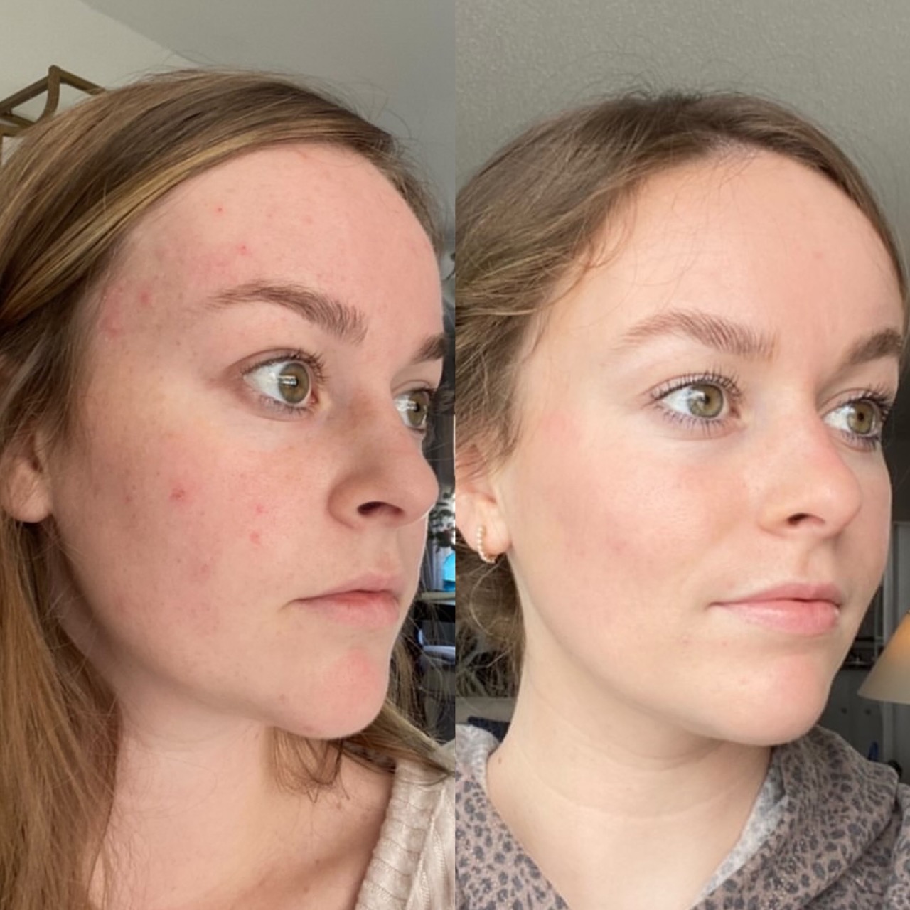 before + after ZO Skin Health regimen