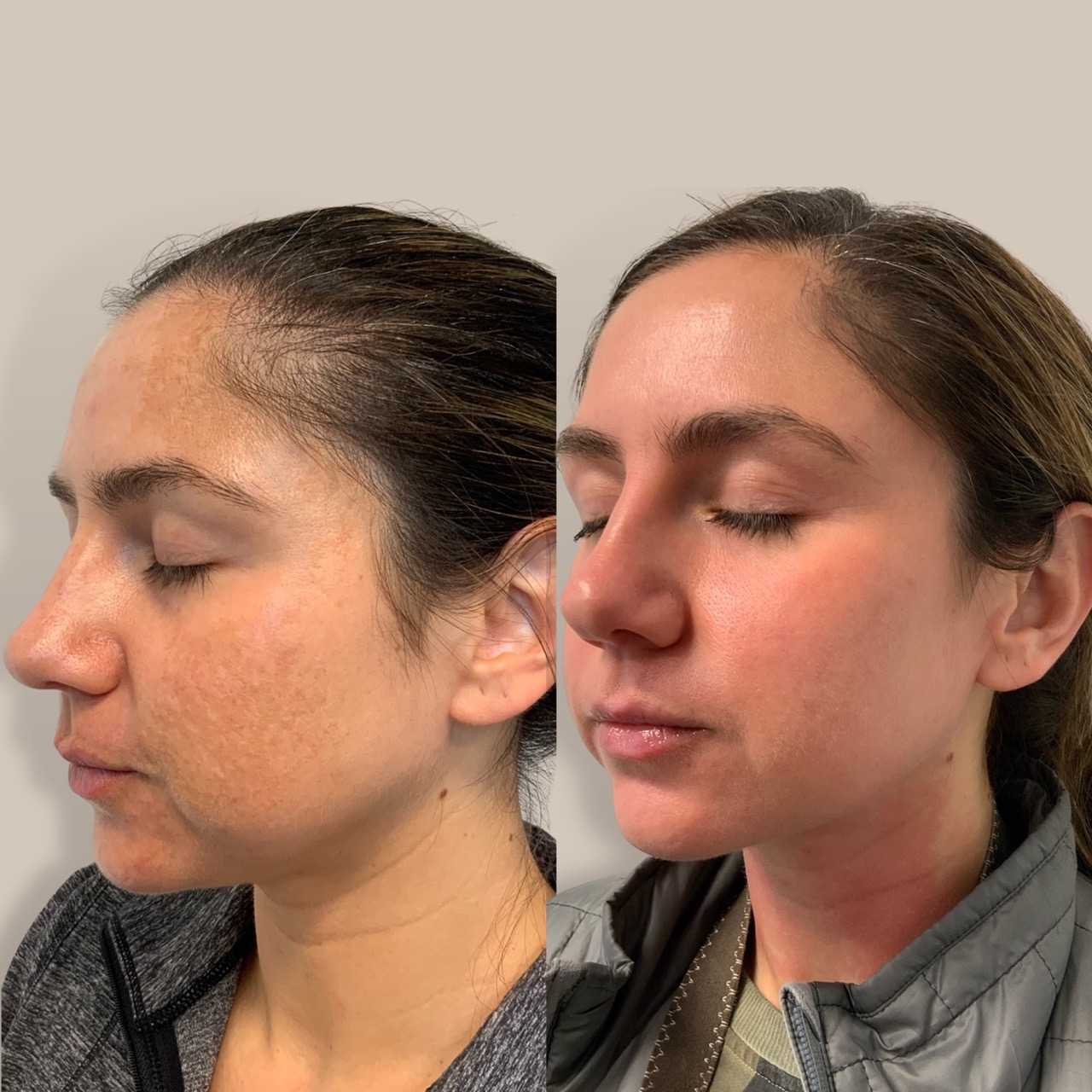 ZO Skin Health pigment control protocol before and after