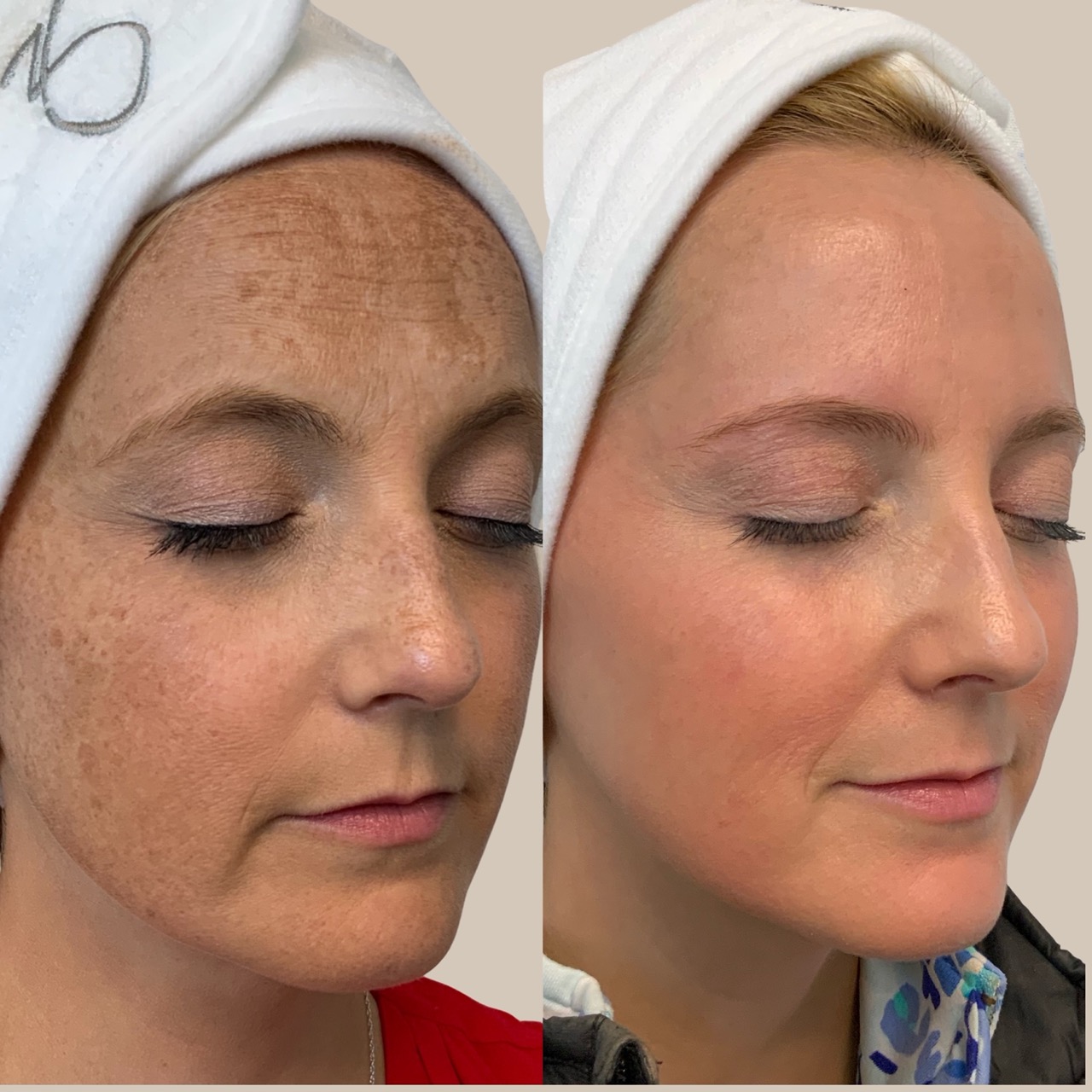 Before and after ZO Skin Health regimen